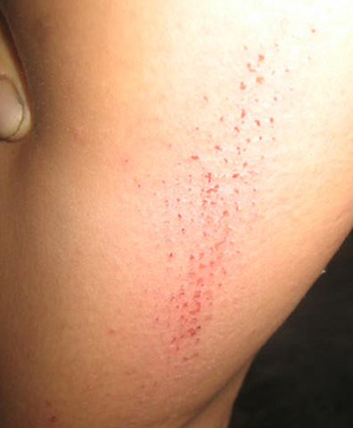 Vết[-]cắn[-]của[-]đàn[-]bướm[-]nổi[-]trên[-]da[-]ngư[-]dân[-]Trần[-]Ngọc[-]Bảy